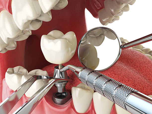 Best Emergency Denture Repair in Springville, NY